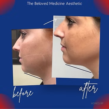 Before and After at The Beloved Medicine Clinic and Pain Center in Dallas, TX