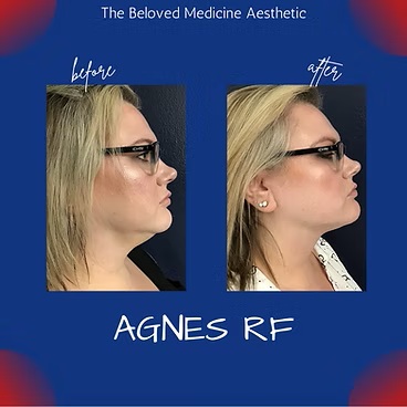 Before and After at The Beloved Medicine Clinic and Pain Center in Dallas, TX